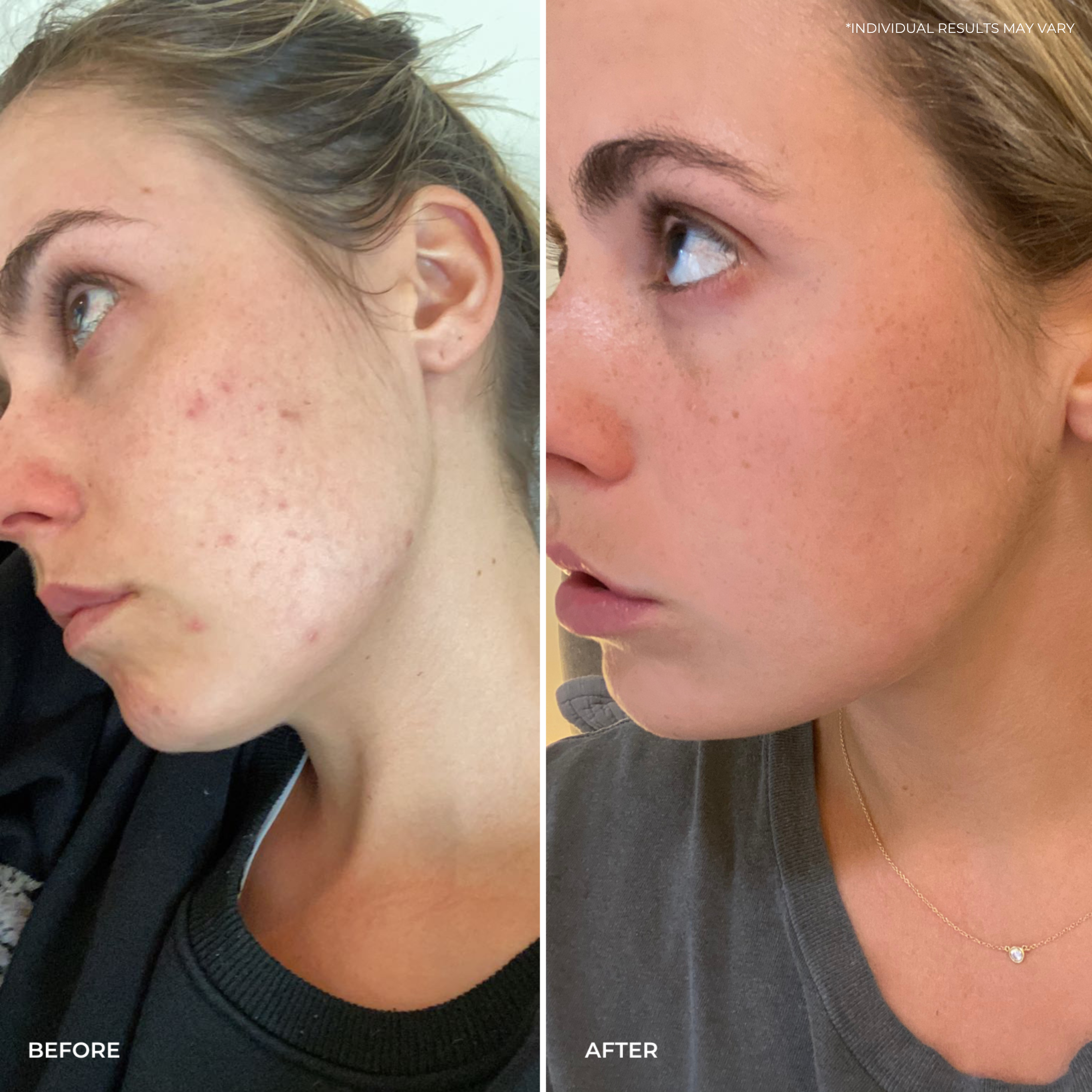 Side-by-side photos show a woman’s face before and after using THE GOLDEN SECRETS Cleansing Ritual Kit. The left image displays visible acne and redness, illustrating the effects of improper cleansing, while the right image reveals clearer, smoother, more radiant skin—demonstrating the benefits of a proper skincare routine with THE GOLDEN SECRETS Cleansing Ritual Kit. Text reads “before” and “after.”.