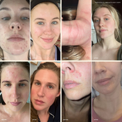 A collage of eight before-and-after photos shows clearer skin—improved acne, redness, and eczema—on several women and one arm after using Heal All Oil by THE GOLDEN SECRETS. Inspired by Polynesian traditions. Individual results may vary.