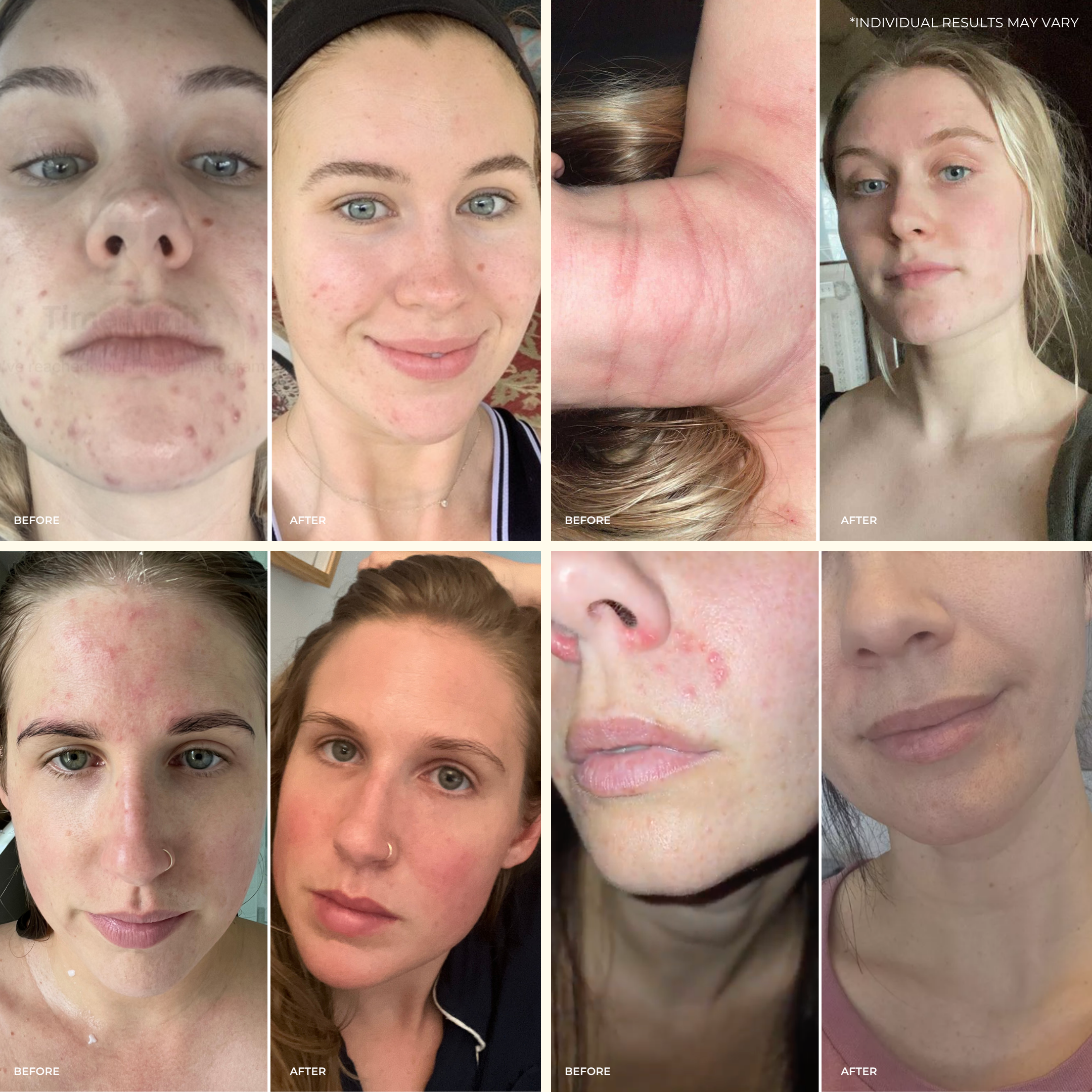 A collage of eight before-and-after photos shows clearer skin—improved acne, redness, and eczema—on several women and one arm after using Heal All Oil by THE GOLDEN SECRETS. Inspired by Polynesian traditions. Individual results may vary.
